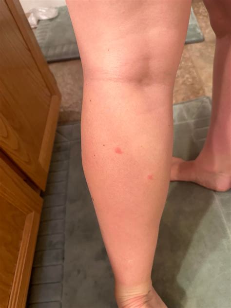 Carpet beetle rash? : r/carpetbeetles