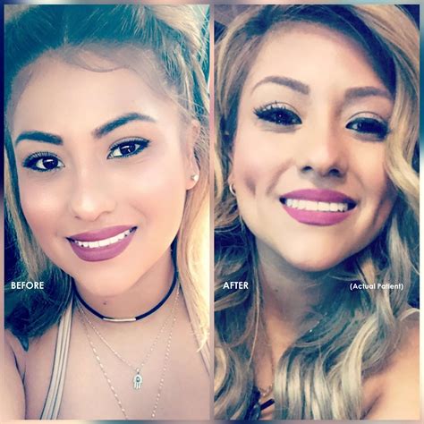 Dimple Creation Surgery Before And After