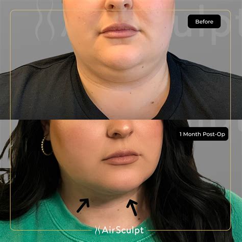 How Much Does Chin Liposuction Cost in 2024? | AirSculpt