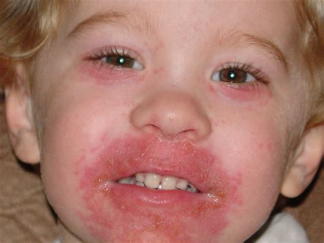 Eczema Around Mouth Child at Joel Norris blog