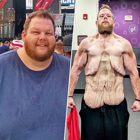 He started walking and lost 360 pounds. But loose skin makes him feel 'trapped'