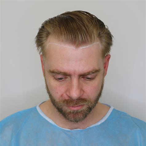Greg Shepherd Hair Transplant at KSL Clinic // See the results here