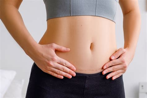 Cicatriz de una cesárea: ¿sabes cómo mejorar su aspecto? | Winny