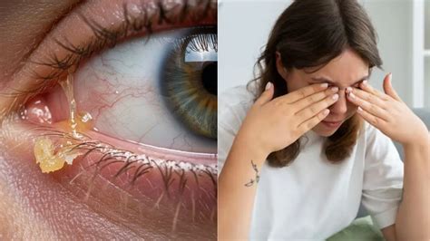 Watery Eyes: आंखों में बार-बार आ रहा है कीचड़, इन्फेक्शन है या विटामिन ...