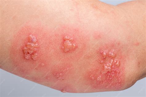Premium Photo | Shingles, Zoster or Herpes Zoster symptoms on arm