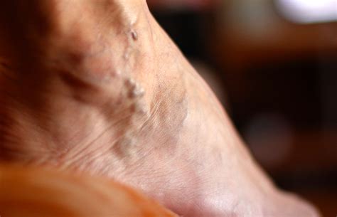 Lump In A Vein