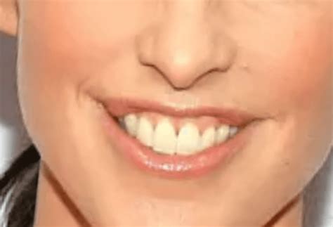 catherine reitman botched lips Archives - HealthCarter