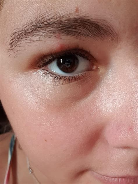 Swollen Eye Ingrown Eyebrow Hair at Terence Fanning blog