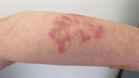 Kaposi Sarcoma Lesions Like