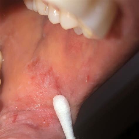 Why does the skin inside of your mouth peel? - Vetri Dental Care Centre