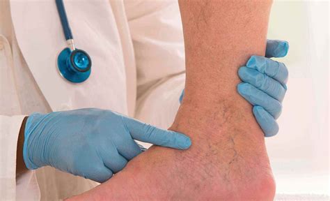 Leg Vein Conditions | Vein Clinic Perth