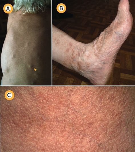 Ehlers-Danlos syndrome | BMJ Case Reports