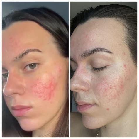 Rosacea Transformation Photos | The Rosacea Method Successes