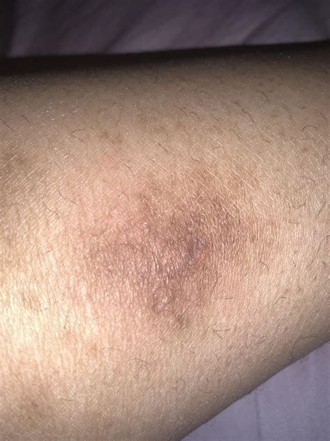 ugly bruise on lower left leg. it’s itchy too. how do i get rid of it? : r/DermatologyQuestions