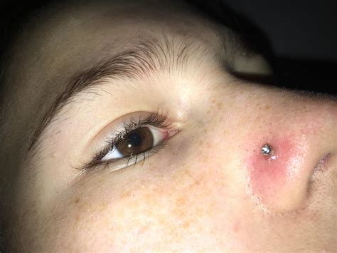 What Are Nose Piercing Bumps at Stephanie Fleming blog