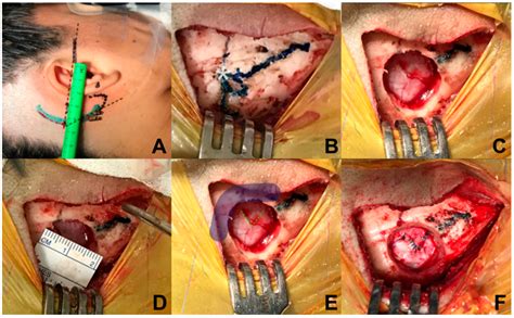Minimally Invasive Retrosigmoidal Parasterional Burr-Hole Approach ...