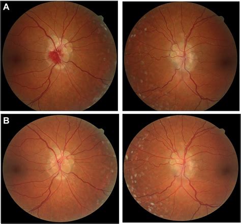 Intrapapillary Hemorrhage and Optic Disc Drusen - Ophthalmology