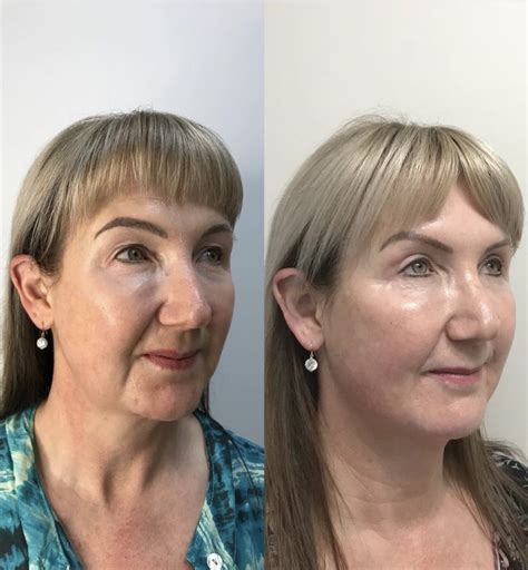 Threadlift | Non-surgical Face Lift | Available at Body Dezign House