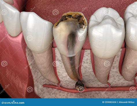 Periostitis Tooth - Lump on Gum Above Tooth. Medically Accurate Dental ...