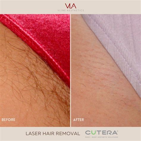 Laser Bikini Hair Removal