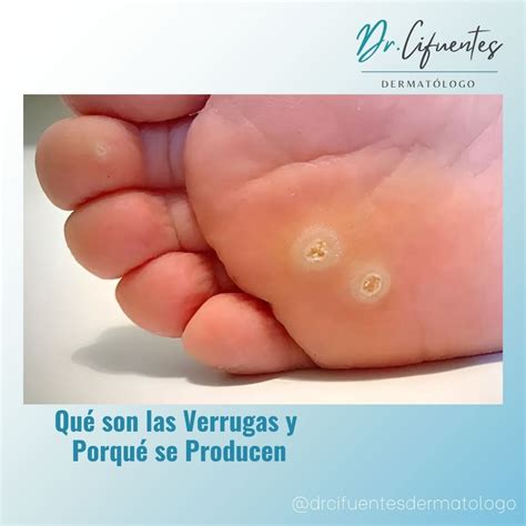 Qué son las Verrugas y por Qué se Producen - Doctor Cifuentes Dermatologo