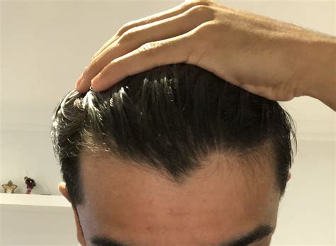Receding Hairline Signs