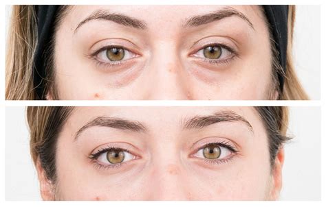Remove Under Eye Bags Without Surgery