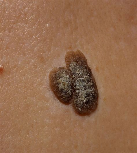Seborrheic Keratosis - Hayley's Hair Removal and Aesthetics - Poole