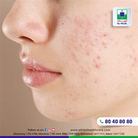 Acne Vulgaris Causes