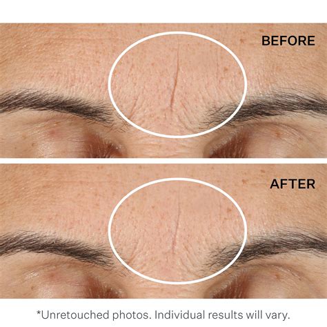 Scientifically Proven Ways To Remove Wrinkles Flash Sales ...