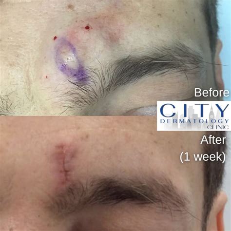 Before & After Photos Cyst Removal