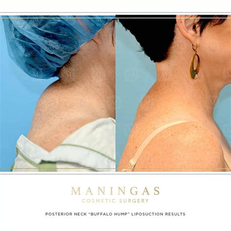 Buffalo Hump Before And After