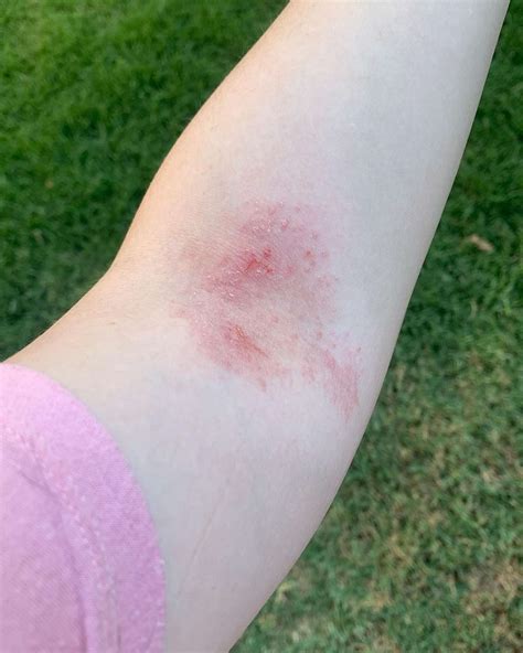 Water Allergic Reaction Hives at Carolyn Cotter blog