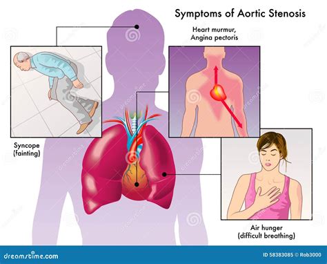 Narrowing Of Aorta Symptoms