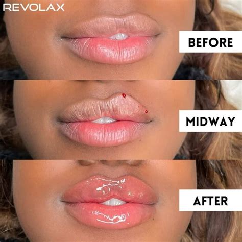 Lip Filler Before and After Photos and Results - the daily glimmer