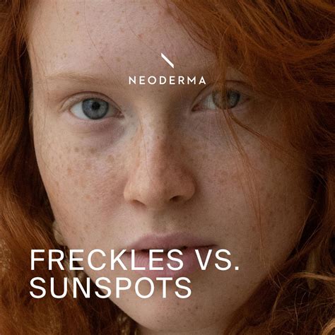 Freckles Vs Sunspots | Topical Treatments & Natural Skincare Products ...