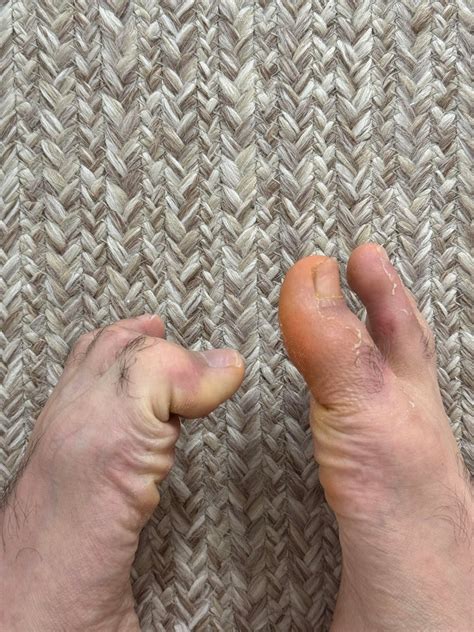 Big toe fracture not bending : r/FootFunction