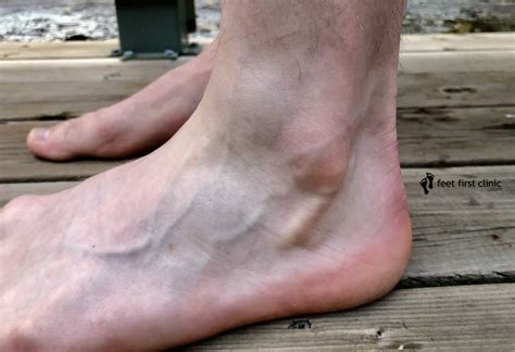 Ganglion Cyst On Top Of The Foot: What Is It? - Feet First Clinic