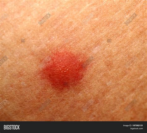 Biggest Mosquito Bite