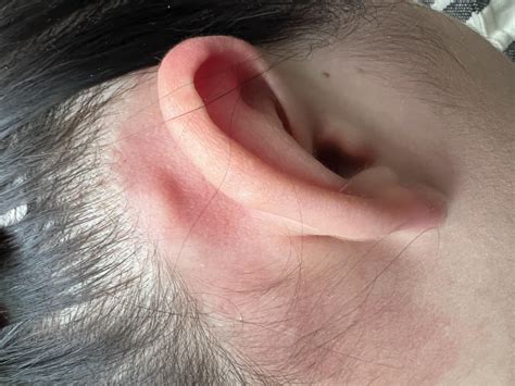 Lumps Behind The Ears - Lump Behind The Ear Causes - JMNBC