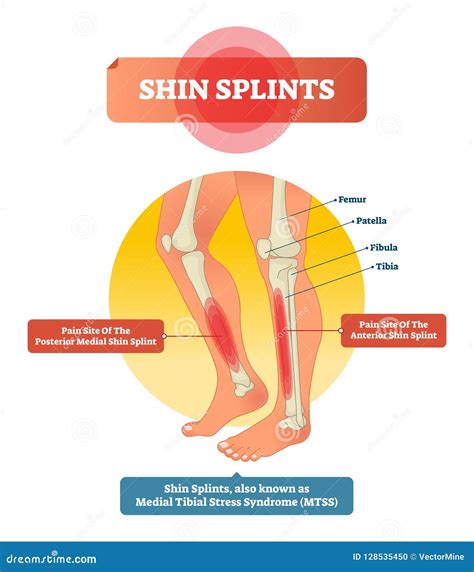 Shin Splints Vector Illustration. Leg Muscle Sport Trauma and Bone Pain. Stock Vector ...