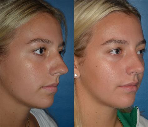 Rhinoplasty Gone Wrong