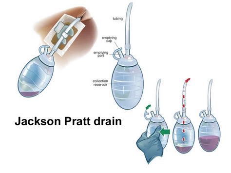 Jackson Pratt drain uses, care, Jackson Pratt clogged & complications