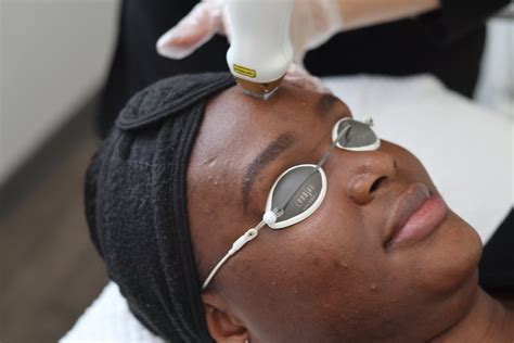 Best Treatments for Hyperpigmentation: A Deep Dive