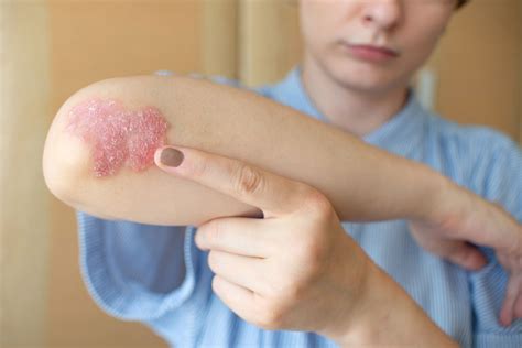 Psoriasis Flare-Ups: How to Prevent and Treat Them - Aesthetic Dermatology