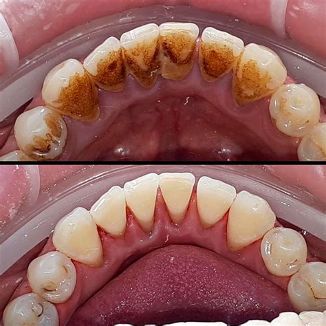 black tartar on teeth