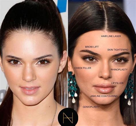 Kendall jenner before and after – Artofit