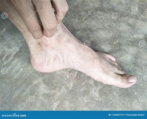 Mosquito bites scars stock photo. Image of bites, care - 116444714