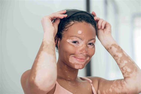 Vitiligo | ClairéDerma