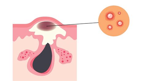 Is Nipple Pimple a Warning Sign of Breast Cancer? | Breast Screening Sg